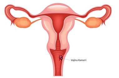 Vajina Kanseri