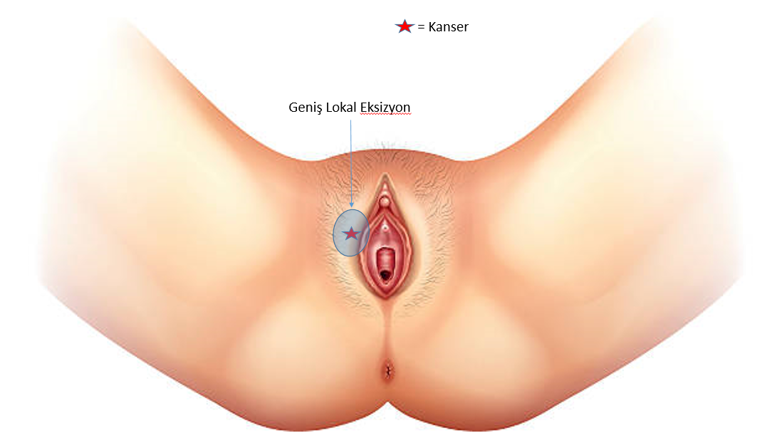 Vulva Kanseri