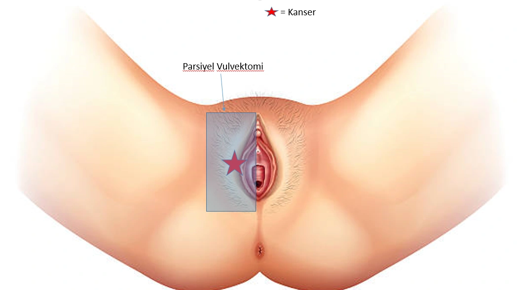 Vulva Kanseri